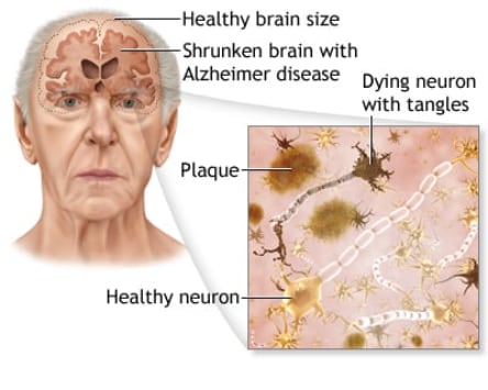 Alzheimer’s prevention